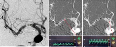 Hemodynamic Versus Anatomic Assessment of Symptomatic Atherosclerotic Middle Cerebral Artery Stenosis: the Relationship Between Pressure Wire Translesional Gradient and Angiographic Lesion Geometry